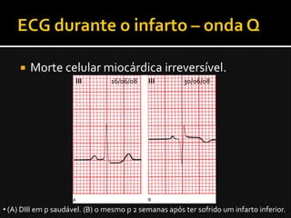    Morte celular miocárdica irreversível.
                      III        16/06/08   III        30/06/08




• (A) DIII em p saudável. (B) o mesmo p 2 semanas após ter sofrido um infarto inferior.
 