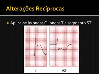    Aplica-se às ondas Q, ondas T e segmento ST.
 