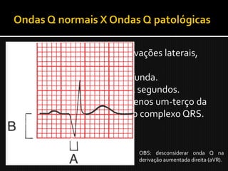  Pequenas ondas Q em derivações laterais,
  laterais altas e inferiores;
 Q patológica: ampla e profunda.
  1. Duração de mais de 0,04 segundos.
  2. Profundidade de pelo menos um-terço da
  altura da onda R no mesmo complexo QRS.


                           OBS: desconsiderar onda Q na
                           derivação aumentada direita (aVR).
 