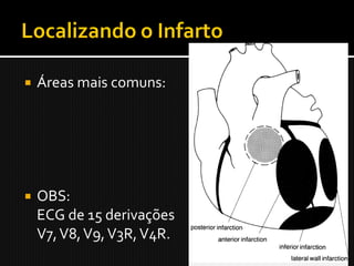    Áreas mais comuns:




   OBS:
    ECG de 15 derivações
    V7, V8, V9, V3R, V4R.
 