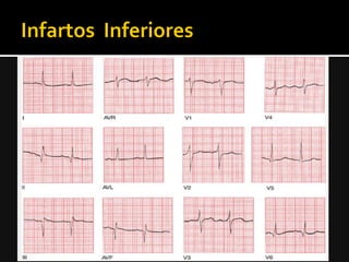    Oclusão da CD ou seu ramo descendente.
   II, III e aVF (alterações recíprocas em
    derivações anteriores e laterais esquerdas).
 