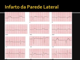    Oclusão da ACx
   I, aVL, V5 e V6 (alt. rec. nas derivações inf.).
 