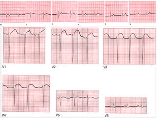    Oclusão da DA (V1 a V6);
   Oclusão de tronco da DA altera tbém I e aVL;
   Nem sempre associado com form. ondas Q;
   Perda da progressão da onda R
    ¤ IAM
    ¤ HVD
    ¤ colocação inadequada dos eletrodos
 