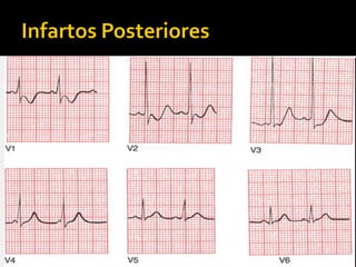  Oclusão de CD;
 Alt. recíprocas nas derivações anteriores;
 Procurar por depressões do ST e ondas R
  elevadas nas derivações anteriores (V1);
 CD irriga VD e zona inferior;
 Diferenciar de HVD ( há também desvio de
  eixo para a direita).
 