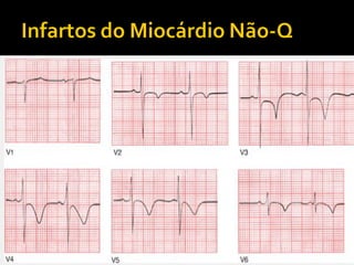    Nem todos os infartos
    produzem ondas Q.
 