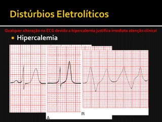 Qualquer alteração no ECG devido a hipercalemia justifica imediata atenção clínica!
      Hipercalemia
 