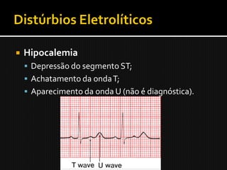    Hipocalemia
     Depressão do segmento ST;
     Achatamento da onda T;
     Aparecimento da onda U (não é diagnóstica).
 