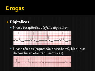    Digitálicos
     Níveis terapêuticos (efeito digitálico)




     Níveis tóxicos (supressão do nodo AS, bloqueios
      de condução e/ou taquiarritmias)
 