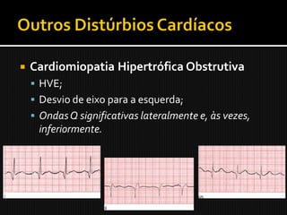    Cardiomiopatia Hipertrófica Obstrutiva
     HVE;
     Desvio de eixo para a esquerda;
     Ondas Q significativas lateralmente e, às vezes,
     inferiormente.
 