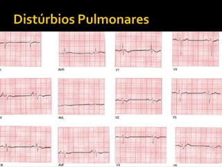    Doença Pulmonar Obstrutiva Crônica (DPOC)
   Enfisema de longa duração
     Baixa voltagem;
     Desvio do eixo para a direita;
     Perda da progressão da onda R;
     Cor pulmonale ( p pulmonale e HVD).
 