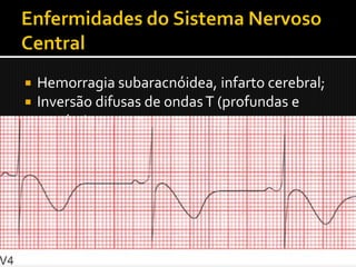  Hemorragia subaracnóidea, infarto cerebral;
 Inversão difusas de ondas T (profundas e
  amplas);
 Ondas U proeminentes;
 Bradicardia sinusal;
 Possivelmente devido a comprometimento
  do sistema nervoso autônomo.
 