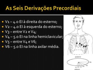    V1 – 4.o EI à direita do esterno;
   V2 – 4.o EI à esquerda do esterno;
   V3 – entre V2 e V4;
   V4 – 5.o EI na linha hemiclavicular;
   V5 – entre V4 e V6;
   V6 – 5.o EI na linha axilar média.
 