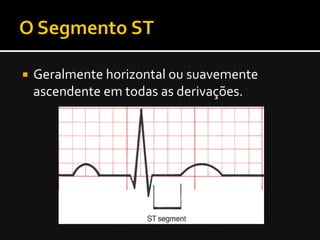    Geralmente horizontal ou suavemente
    ascendente em todas as derivações.
 