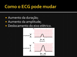    Aumento da duração;
   Aumento da amplitude;
   Deslocamento do eixo elétrico.
 