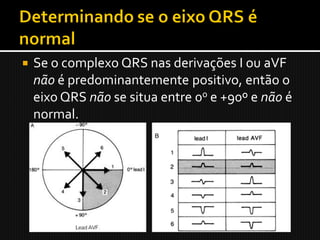    Se o complexo QRS nas derivações I ou aVF
    não é predominantemente positivo, então o
    eixo QRS não se situa entre 0o e +90º e não é
    normal.
 