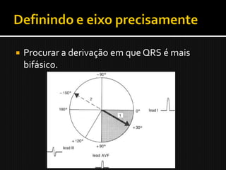    Procurar a derivação em que QRS é mais
    bifásico.
 