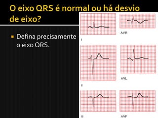    Defina precisamente
    o eixo QRS.
 