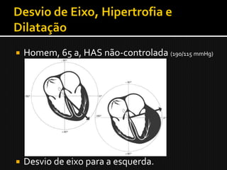    Homem, 65 a, HAS não-controlada (190/115 mmHg)




   Desvio de eixo para a esquerda.
 