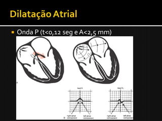    Onda P (t<0,12 seg e A<2,5 mm)
 