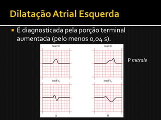    É diagnosticada pela porção terminal
    aumentada (pelo menos 0,04 s).

                                           P mitrale
 