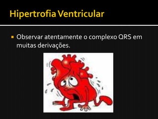    Observar atentamente o complexo QRS em
    muitas derivações.
 