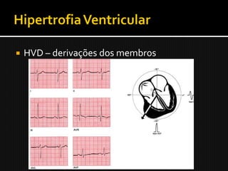    HVD – derivações dos membros
 