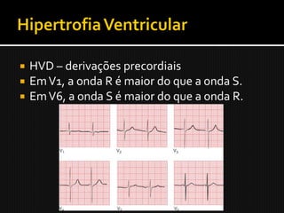    HVD – derivações precordiais
   Em V1, a onda R é maior do que a onda S.
   Em V6, a onda S é maior do que a onda R.
 