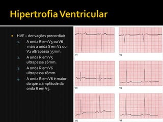    HVE – derivações precordiais
    1.   A onda R em V5 ou V6
         mais a onda S em V1 ou
         V2 ultrapassa 35mm.
    2.   A onda R em V5
         ultrapassa 26mm.
    3.   A onda R em V6
         ultrapassa 18mm.
    4.   A onda R em V6 é maior
         do que a amplitude da
         onda R em V5.
 
