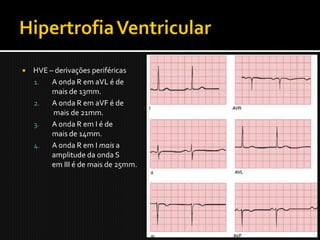    HVE – derivações periféricas
    1.   A onda R em aVL é de
         mais de 13mm.
    2.   A onda R em aVF é de
         mais de 21mm.
    3.   A onda R em I é de
         mais de 14mm.
    4.   A onda R em I mais a
         amplitude da onda S
         em III é de mais de 25mm.
 