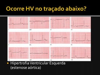    Hipertrofia Ventricular Esquerda
    (estenose aórtica)
 