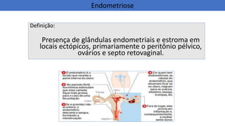 Definição:
Presença de glândulas endometriais e estroma em
locais ectópicos, primariamente o peritônio pélvico,
ovários e septo retovaginal.
Endometriose
 
