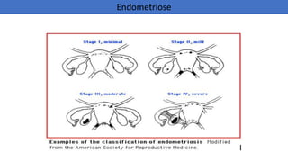 Endometriose
 