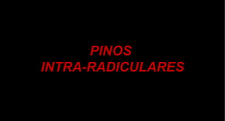 PINOS  INTRA-RADICULARES 