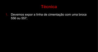 Técnica Devemos expor a linha de cimentação com uma broca 556 ou 557; 
