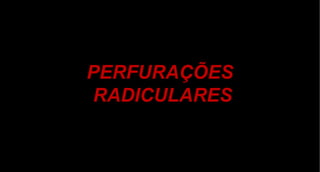 PERFURAÇÕES  RADICULARES 