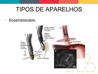 TIPOS DE APARELHOS
• Ecoendoscópio
 