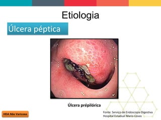Etiologia
HDA Não Varicosa
Úlcera péptica
Fonte: Serviço de Endoscopia Digestiva
Hospital Estadual Mario Covas
Úlcera prépilórica
 