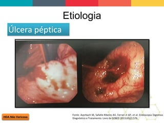 Etiologia
HDA Não Varicosa
Úlcera péptica
Fonte: Averbach M, Safatle-Ribeiro AV, Ferrari Jr AP, et al. Endoscopia Digestiva:
Diagnóstico e Tratamento. Livro da SOBED 2013;65(2):576.
 