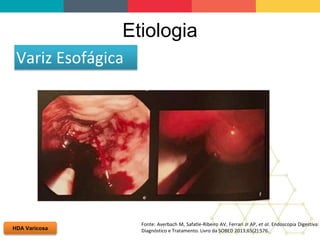 Etiologia
HDA Varicosa
Variz Esofágica
Fonte: Averbach M, Safatle-Ribeiro AV, Ferrari Jr AP, et al. Endoscopia Digestiva:
Diagnóstico e Tratamento. Livro da SOBED 2013;65(2):576.
 