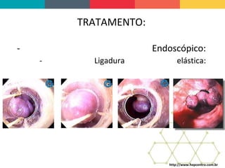 TRATAMENTO:
- Endoscópico:
- Ligadura elástica:
http://www.hepcentro.com.br
 