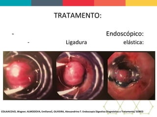 TRATAMENTO:
- Endoscópico:
- Ligadura elástica:
COLAIACOVO, Wagner; ALMODOVA, EmilianoC; OLIVEIRA, Alessandrino T. Endoscopia Digestiva Diagnóstico e Tratamento/ SOBED
 