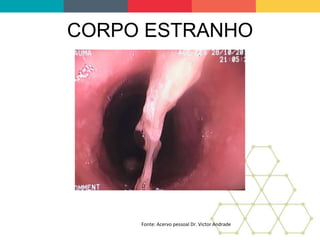 CORPO ESTRANHO
Fonte: Acervo pessoal Dr. Victor Andrade
 