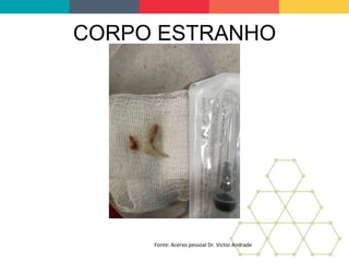 CORPO ESTRANHO
Fonte: Acervo pessoal Dr. Victor Andrade
 