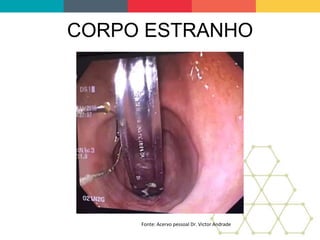 CORPO ESTRANHO
Fonte: Acervo pessoal Dr. Victor Andrade
 