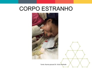 CORPO ESTRANHO
Fonte: Acervo pessoal Dr. Victor Andrade
 