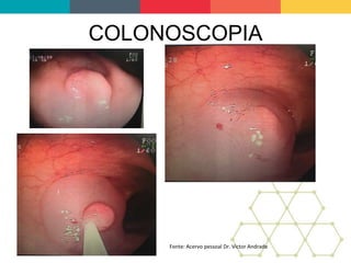 COLONOSCOPIA
Fonte: Acervo pessoal Dr. Victor Andrade
 