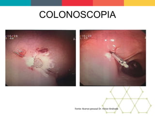 COLONOSCOPIA
Fonte: Acervo pessoal Dr. Victor Andrade
 