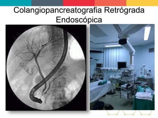 Colangiopancreatografia Retrógrada
Endoscópica
 
