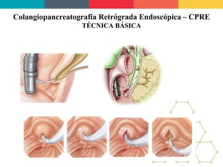 Colangiopancreatografia Retrógrada Endoscópica – CPRE
TÉCNICA BÁSICA
 