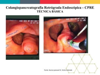 Colangiopancreatografia Retrógrada Endoscópica – CPRE
TÉCNICA BÁSICA
Fonte: Acervo pessoal Dr. Victor Andrade
 